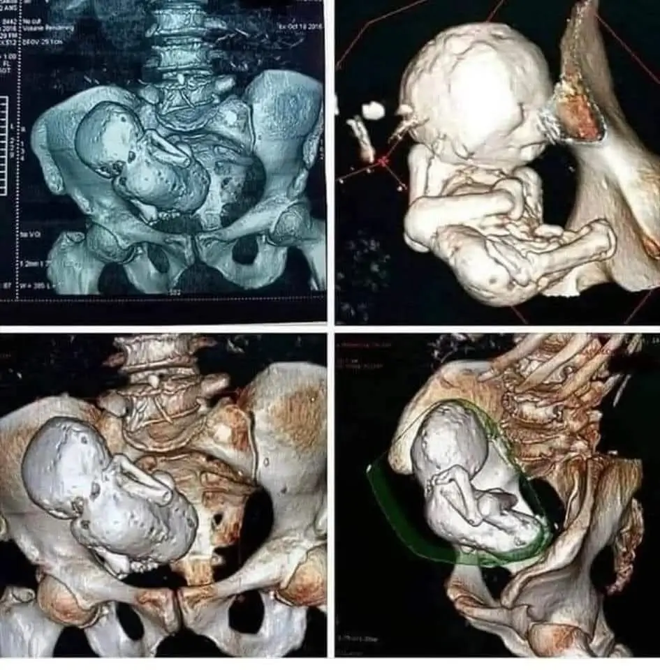 Découvrez le phénomène rare du lithopédion, ou 'bébé de pierre' : quand un fœtus décédé se calcifie dans le ventre de la mère pendant des années